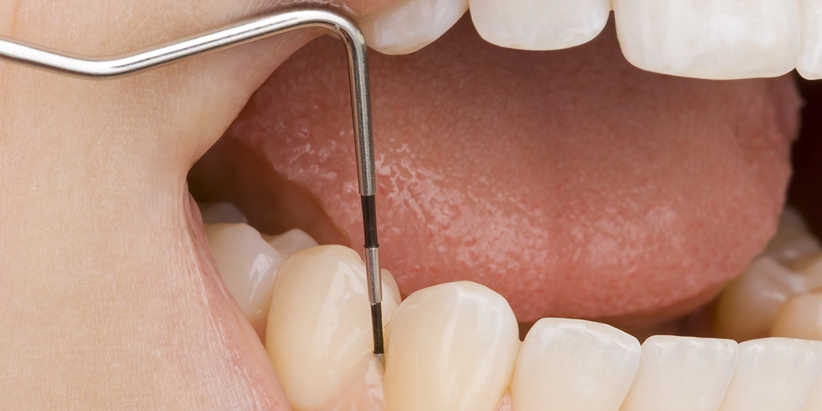 歯周ポケット検査:歯周病の進行度を数値で把握する