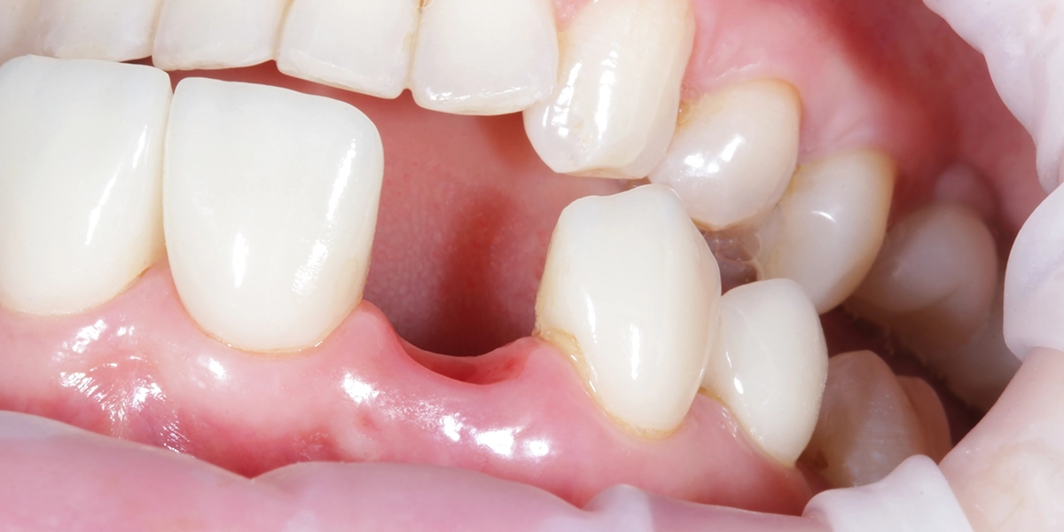 歯の喪失と位置の変化