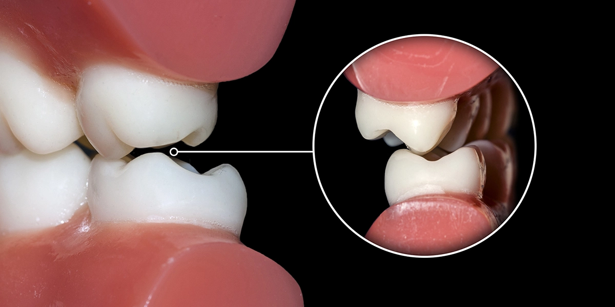 噛み合わせの異常が引き起こす症状