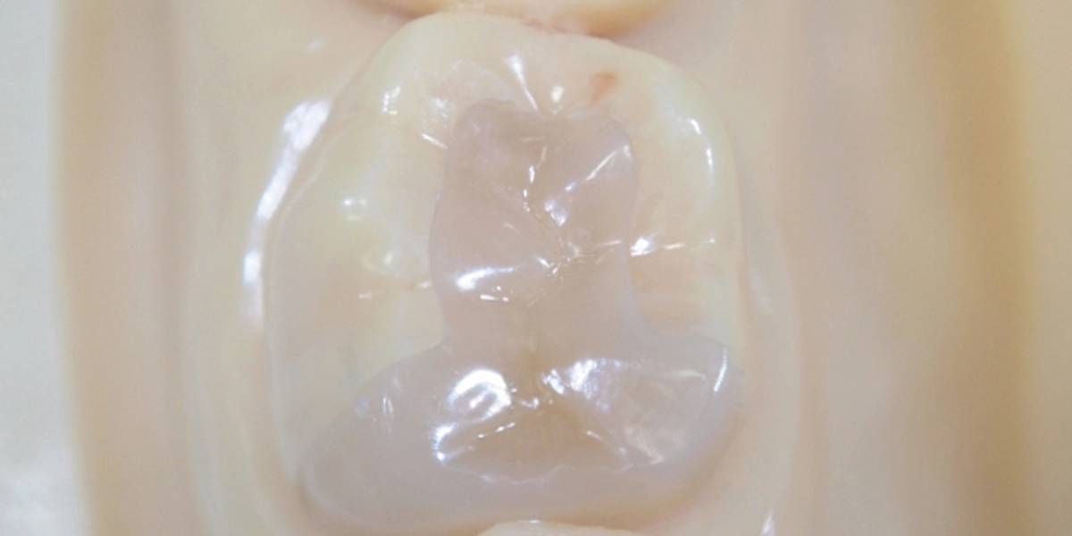 インレー・アンレー(詰め物)