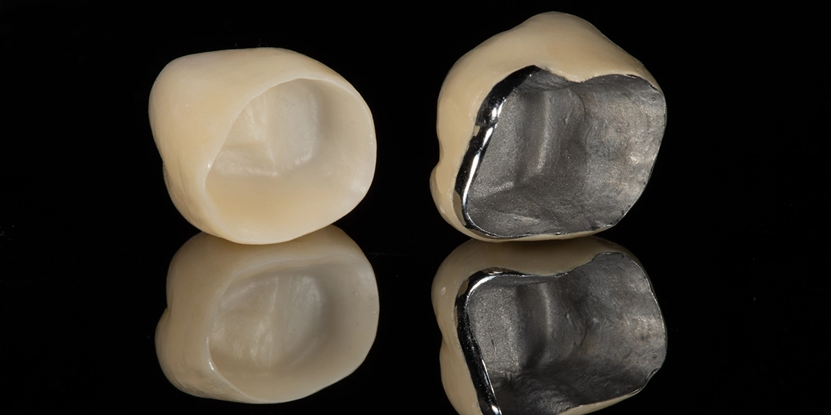 クラウン(被せ物)