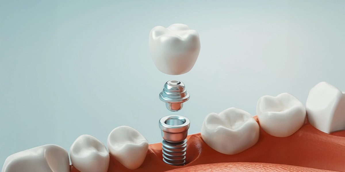 インプラント治療