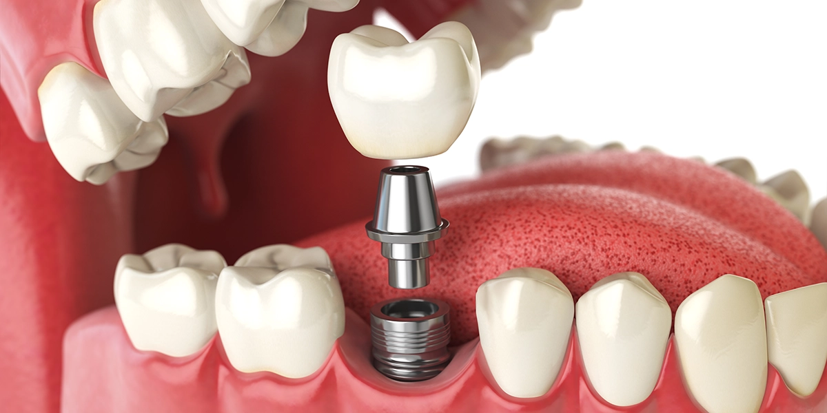 インプラントを構成する3つの部分