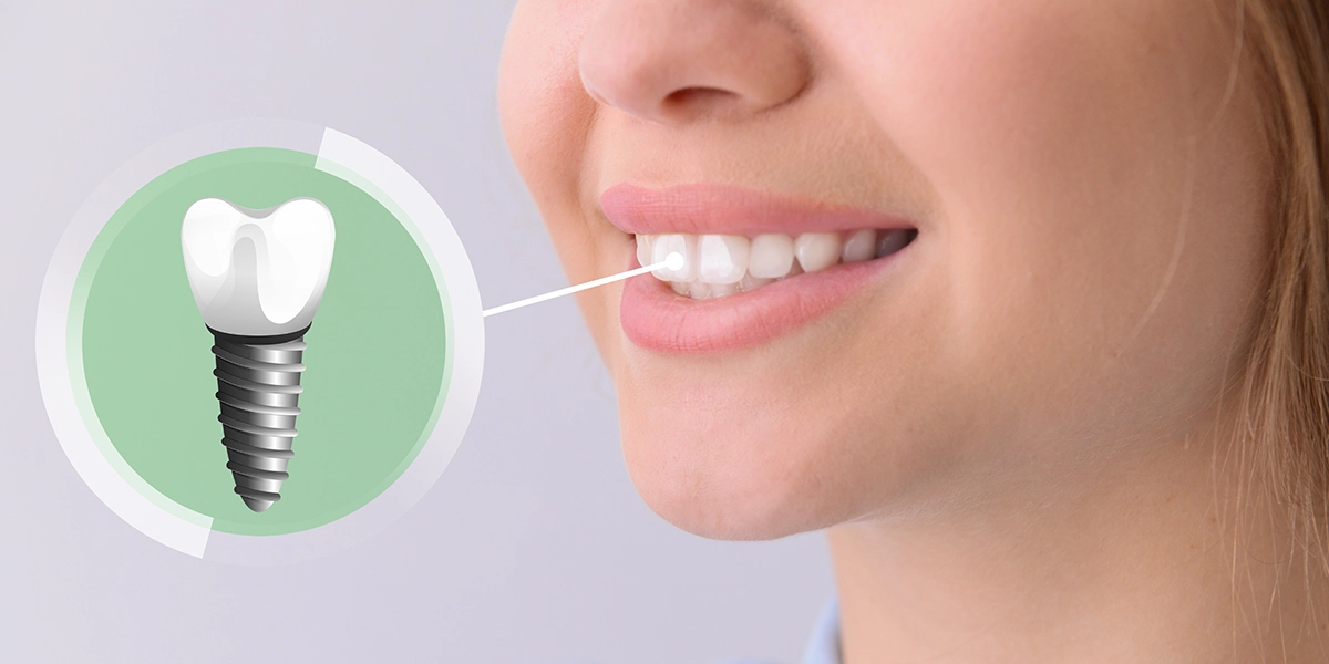 インプラント治療の適応条件と診査