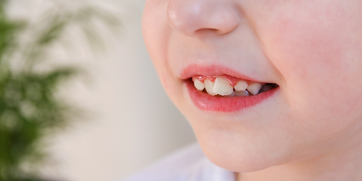 乳歯の役割と虫歯のリスク