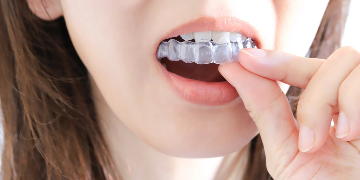 アライナーの装着