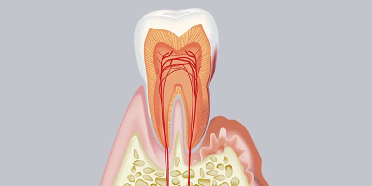 軽度〜中等度歯周炎