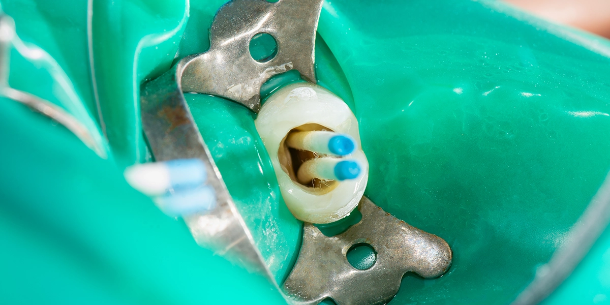 根管充填と土台の構築