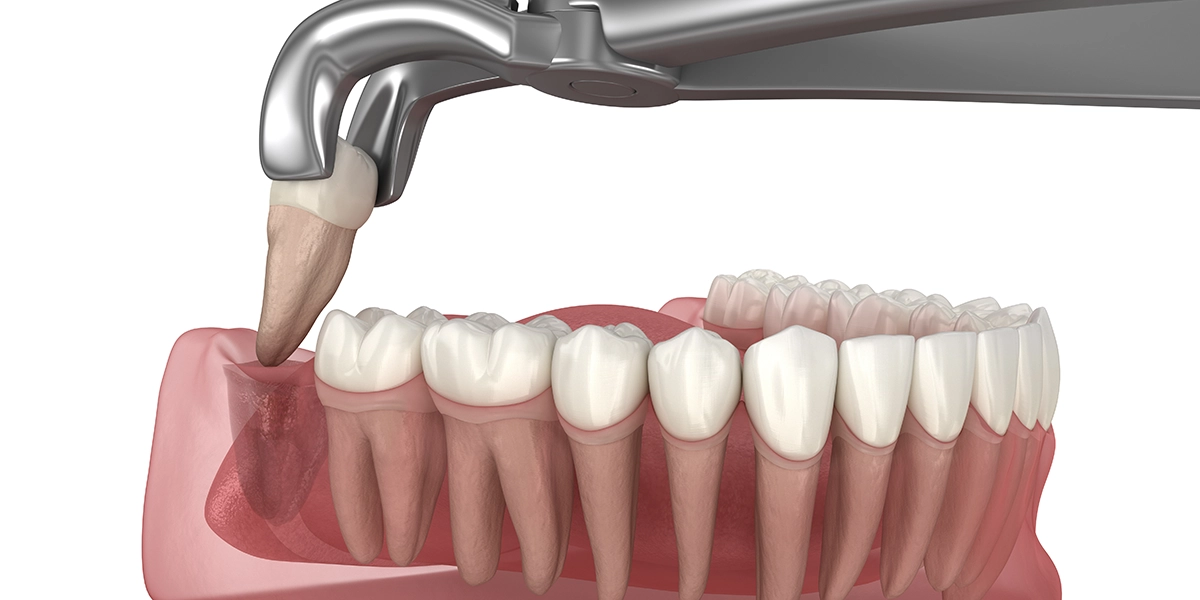 まっすぐ生えている場合