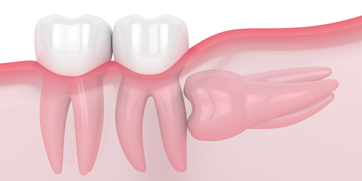 斜めや横向き・骨に深く埋まっている場合