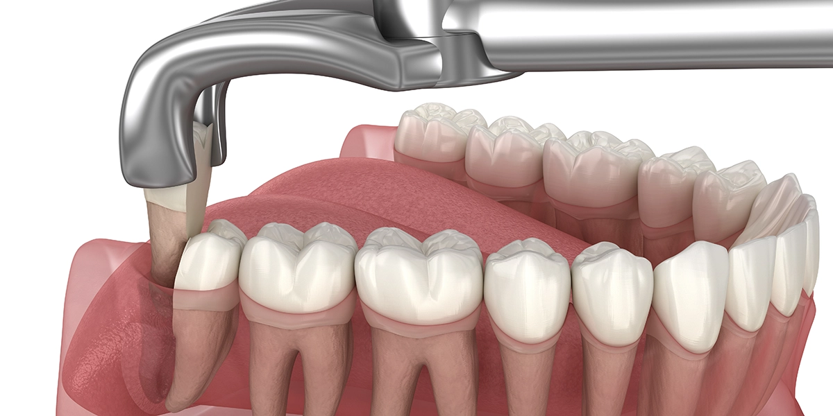 骨に深く埋まっている場合